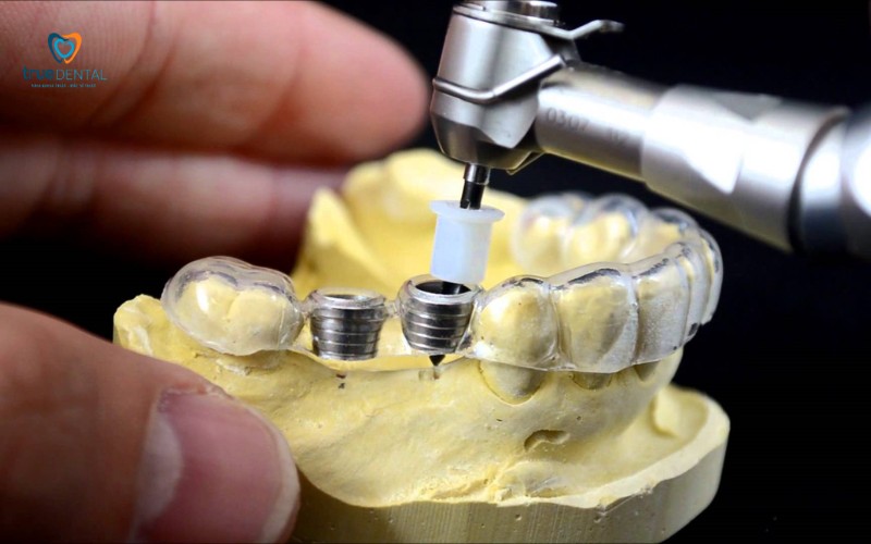 Lợi ích cấy ghép Implant không phẫu thuật