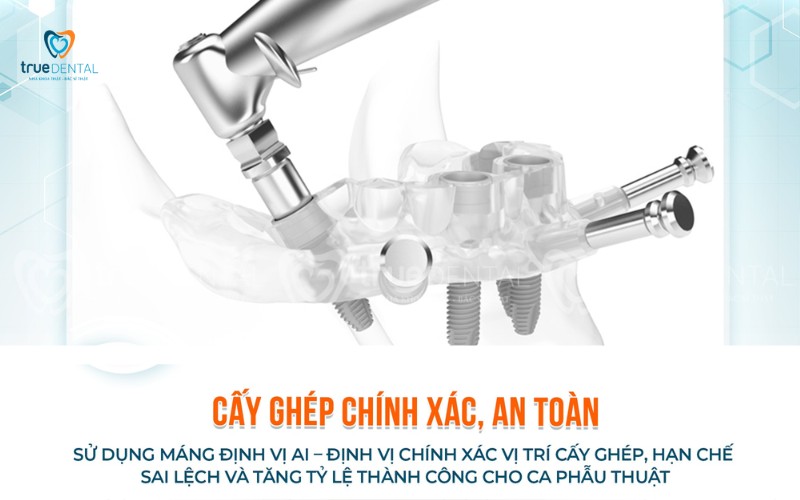 Lợi ích cấy ghép Implant không phẫu thuật