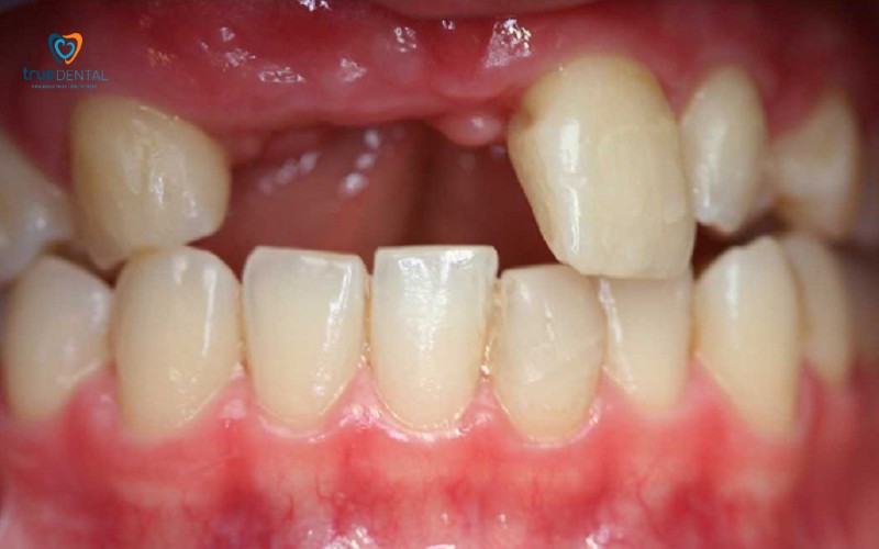 Lợi ích cấy ghép Implant không phẫu thuật