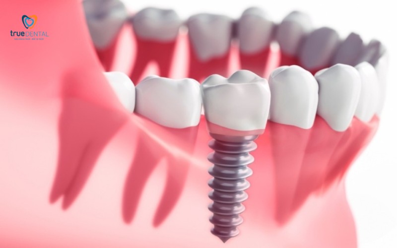 Lợi ích cấy ghép Implant không phẫu thuật