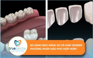 So sánh bọc răng sứ và dán veneer