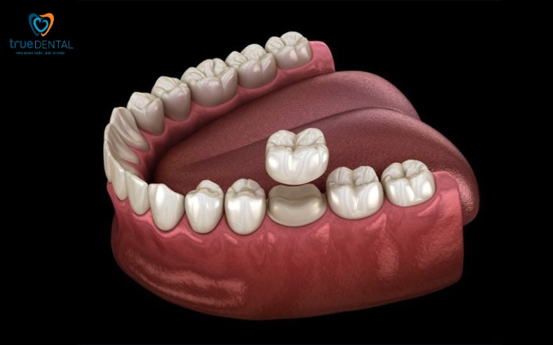 So sánh bọc răng sứ và dán veneer: Phương pháp nào phù hợp hơn? 1 So sánh bọc răng sứ và dán veneer