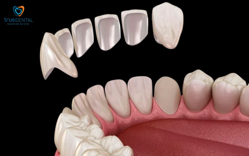 So sánh bọc răng sứ và dán veneer: Phương pháp nào phù hợp hơn? 2 So sánh bọc răng sứ và dán veneer
