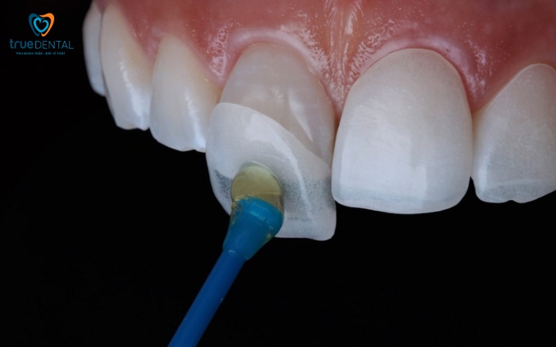 So sánh bọc răng sứ và dán veneer: Phương pháp nào phù hợp hơn? 6 So sánh bọc răng sứ và dán veneer