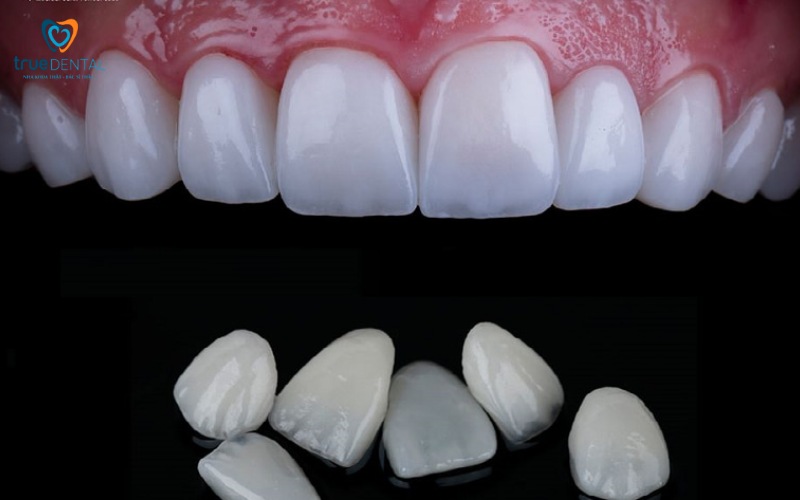 So sánh bọc răng sứ và dán veneer: Phương pháp nào phù hợp hơn? 8 So sánh bọc răng sứ và dán veneer
