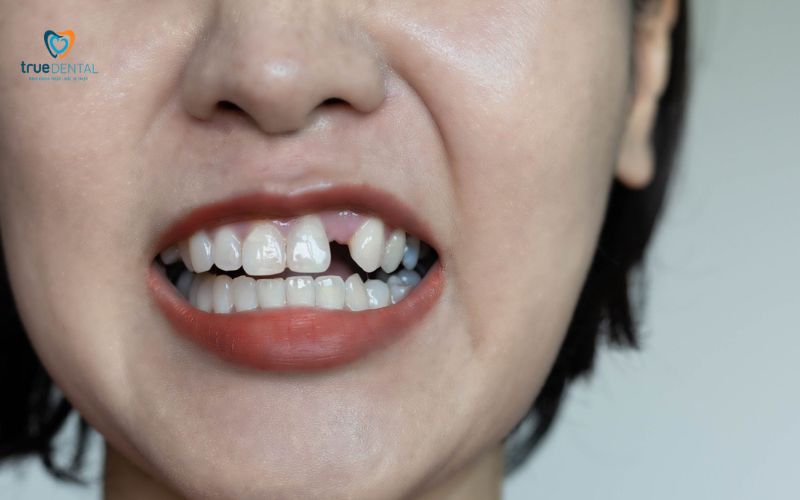 So sánh trụ Implant Titanium và Zirconia: Nên chọn loại nào cho cấy ghép? 3 So sánh trụ Implant Titanium và Zirconia