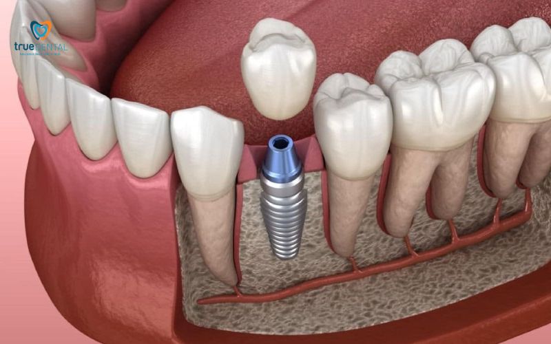 So sánh trụ Implant Titanium và Zirconia: Nên chọn loại nào cho cấy ghép? 4 So sánh trụ Implant Titanium và Zirconia