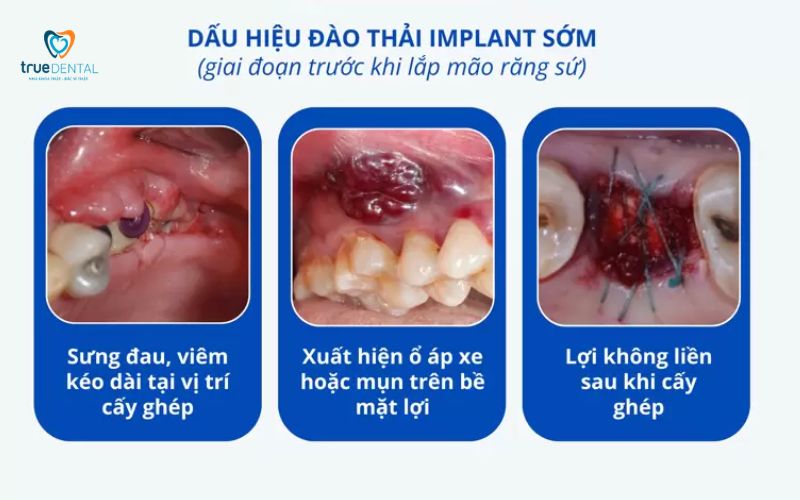 So sánh trụ Implant Titanium và Zirconia: Nên chọn loại nào cho cấy ghép? 5 So sánh trụ Implant Titanium và Zirconia