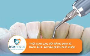 Thời gian cạo vôi răng định kỳ
