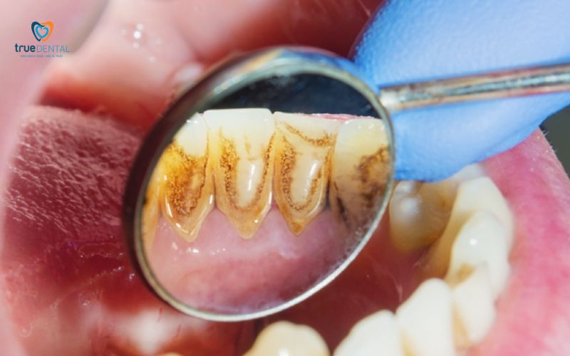 Thời gian cạo vôi răng định kỳ: Bao lâu 1 lần và lợi ích sức khỏe 1 Thời gian cạo vôi răng định kỳ