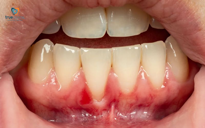 Thời gian cạo vôi răng định kỳ: Bao lâu 1 lần và lợi ích sức khỏe 4 Thời gian cạo vôi răng định kỳ