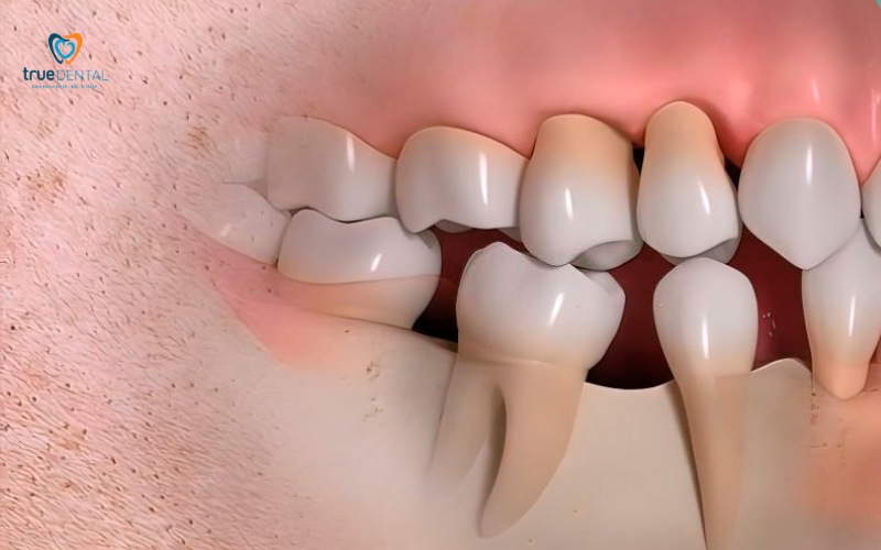 Trụ Implant MIS Israel ưu nhược điểm