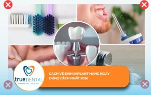 Cách vệ sinh Implant hàng ngày