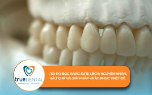 Rủi ro bọc răng sứ bị lệch