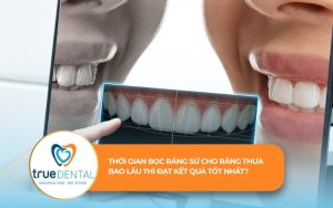 Thời gian bọc răng sứ cho răng thưa
