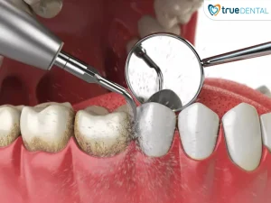 Cách kiểm tra men răng tại nhà