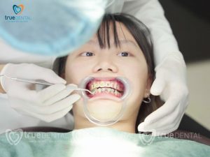 Chi phí niềng răng cho trẻ em tại TP.HCM
