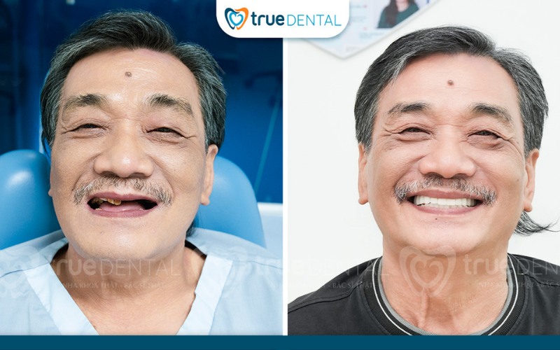 Cấy ghép implant có ảnh hưởng đến giọng nói không? Giải đáp từ chuyên gia True Dental 4 Đầu tư xứng đáng cho giọng nói và chức năng răng miệng