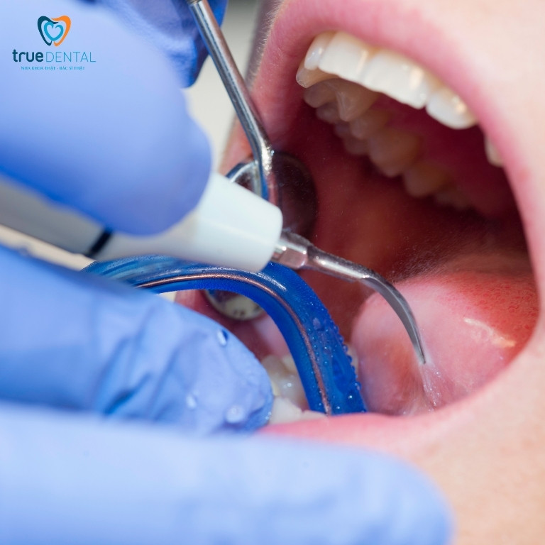 Địa chỉ cạo vôi răng giá tốt tại Sài Gòn