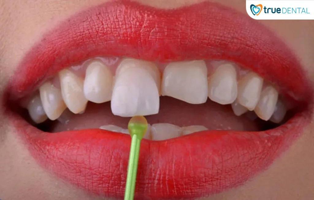 Lợi ích bọc răng sứ không mài nhiều cho sức khỏe răng 3 Đối tượng phù hợp thực hiện bọc răng sứ không mài nhiều tại TP.HCM