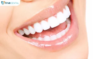 Lợi ích bọc răng sứ không mài nhiều