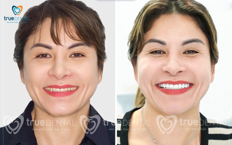 Bọc răng sứ ở người trung niên có an toàn không? 5 Lợi ích vượt trội khi lựa chọn True Dental cho bọc răng sứ ở người trung niên