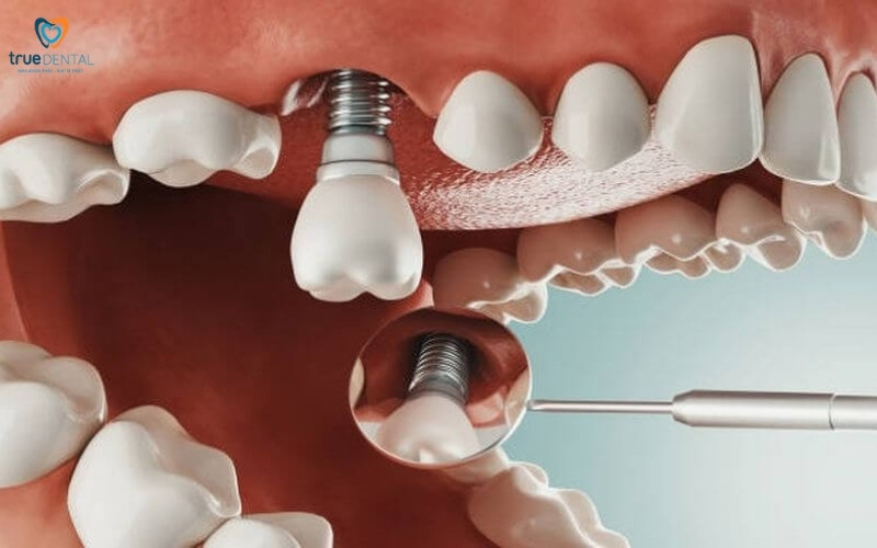 Cấy ghép implant có ảnh hưởng đến giọng nói không? Giải đáp từ chuyên gia True Dental 1 Mất răng ảnh hưởng đến phát âm như thế nào