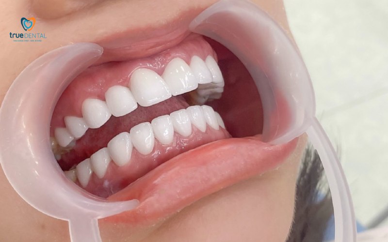 So sánh răng sứ cercon và katana: Loại nào tốt hơn? 5 Quy trình bọc răng sứ cercon và katana chuyên nghiệp 6 bước tại True Dental