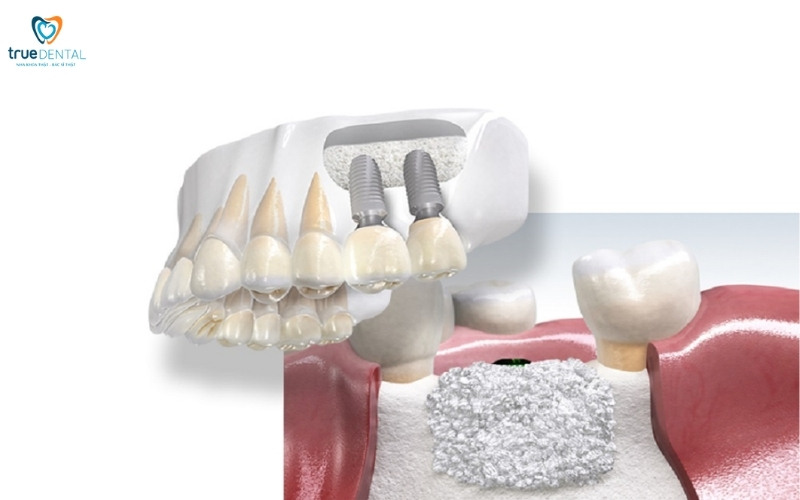 Cấy ghép implant có ảnh hưởng đến giọng nói không? Giải đáp từ chuyên gia True Dental 3 So sánh ảnh hưởng đến giọng nói