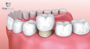 Bọc răng sứ press là gì