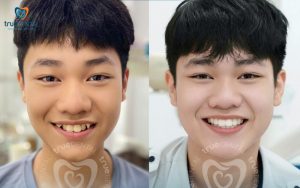 Cách chọn loại niềng răng phù hợp