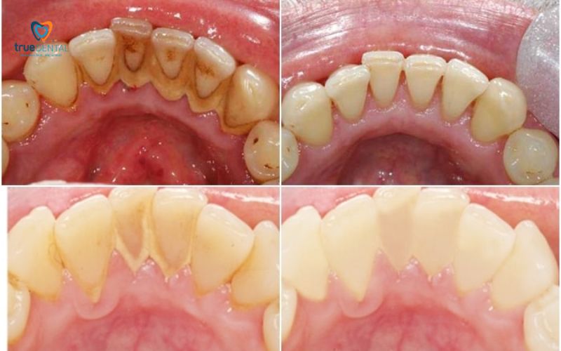 Cần điều trị bệnh lý nha khoa trước