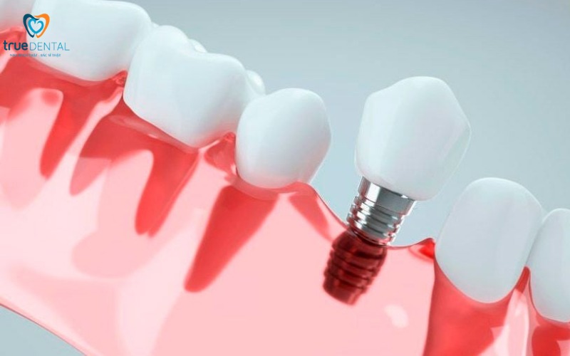 Cao huyết áp ảnh hưởng đến phẫu thuật implant như thế nào