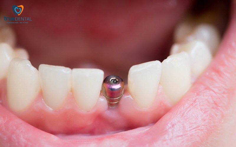 Chăm sóc sau cấy ghép implant ở bệnh nhân cao huyết áp