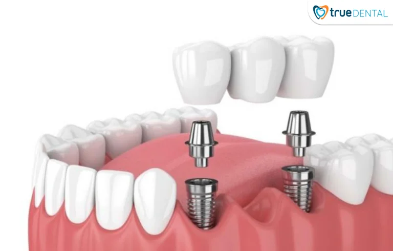 Chi phí cấy ghép implant đơn lẻ cho hàm răng khuyết ít răng