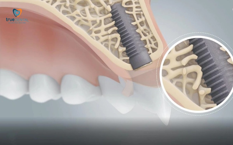 Chi phí cấy ghép implant phụ thuộc vào những yếu tố nào