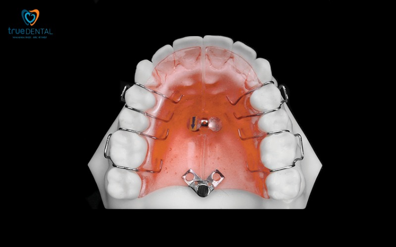Chi phí niềng răng expander cố định và tháo lắp khác nhau như thế nào