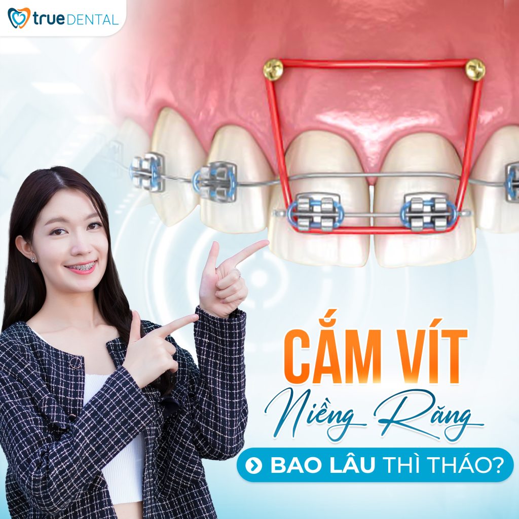 Niềng răng cho răng vẩu nhẹ – Phương pháp, thời gian và chi phí chi tiết nhất 15 Có cần dùng minivis khi niềng răng cho răng vẩu nhẹ không