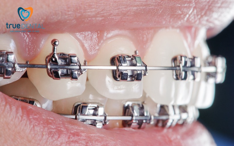 Dấu hiệu tái phát sau niềng răng và cách phát hiện sớm