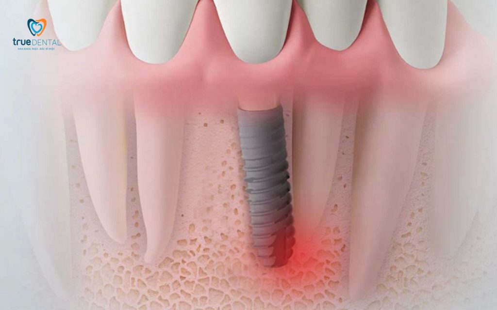 Dị ứng trụ implant là gì