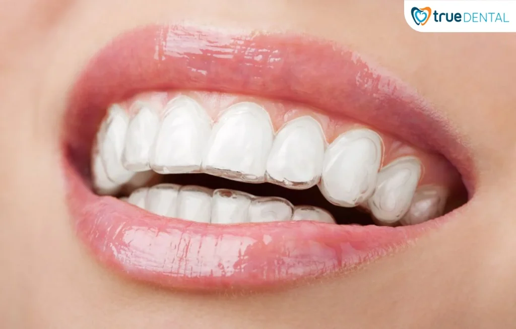 Điều kiện để lợi ích niềng răng lâu dài được duy trì bền vững