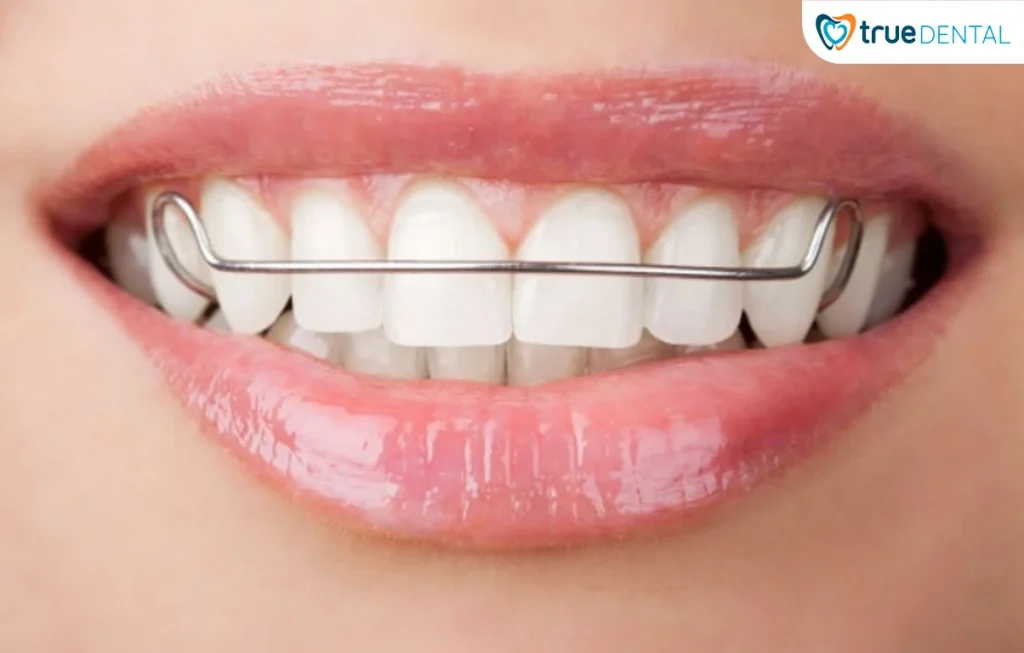 Hàm duy trì sau niềng răng