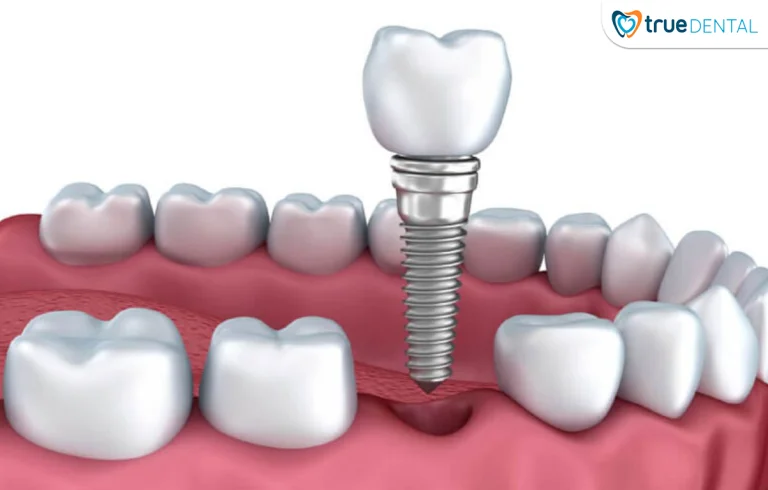 Hàm răng khuyết là gì và tại sao cần cấy ghép implant sớm?