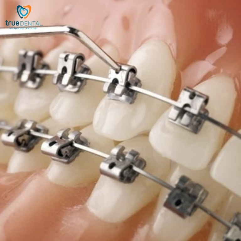 So sánh niềng răng Hàn Quốc và Mỹ – Phân tích chuyên sâu theo từng tiêu chí lâm sàng 13 Hiểu đúng khái niệm trước khi so sánh