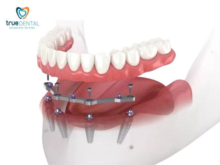 Implant hybrid bao nhiêu tiền