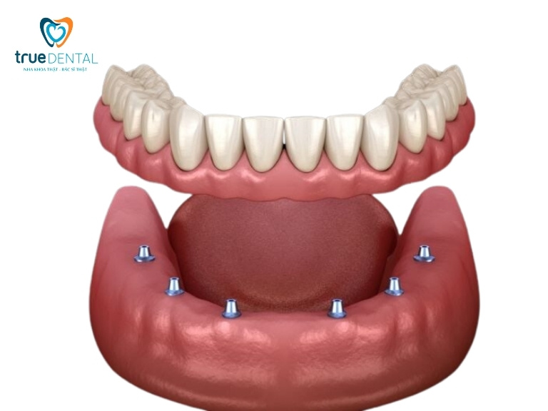 Implant hybrid có bền không