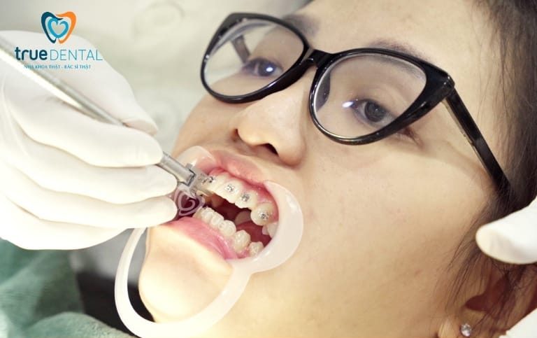 Niềng răng cho răng vẩu nhẹ – Phương pháp, thời gian và chi phí chi tiết nhất 16 Kết quả niềng răng cho răng vẩu nhẹ trông như thế nào và có bị tái phát không