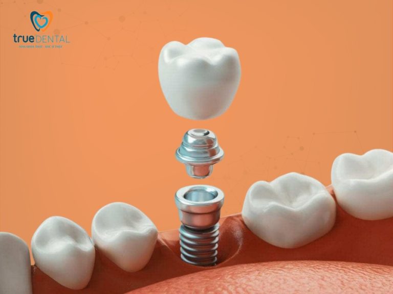 Lợi ích cấy ghép implant lâu dài – Tại sao đây là khoản đầu tư xứng đáng nhất cho sức khỏe răng miệng? 2 Khôi phục chức năng ăn nhai như răng thật