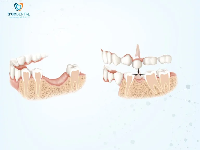 Lợi ích cấy ghép implant lâu dài – Tại sao đây là khoản đầu tư xứng đáng nhất cho sức khỏe răng miệng? 1 Ngăn ngừa tiêu xương hàm