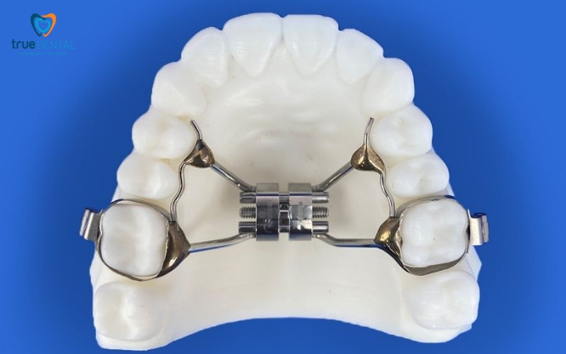 Niềng răng expander mất bao lâu và ảnh hưởng thế nào đến tổng chi phí